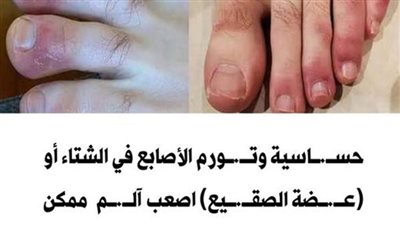 تورم أصابع القدمين في الشتاء أسبابة وهل له مضاعفات؟ وكيف تتجنبه؟