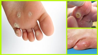 إليكم أسهل وأقوى طرق علاج مسمار القدم