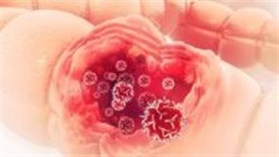 سـرطان القولون أسبابه وطرق التعرف عليه وطرق علاجه والوقاية منه