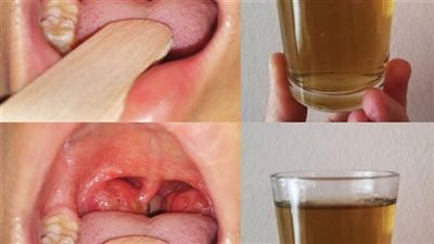 التهاب سقف الحلق أسبابه وعلاجه طبيعيا