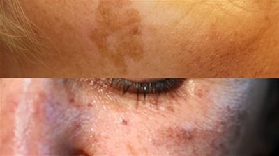 وصفات علاج الكلف ٩ طرق نتيجتها بعد أول استخدام
