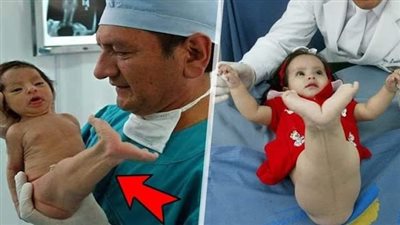 سخروا من هذه الطفلة لأنها ولدت تشبه حـورية البحر..بعد 5 سنوات ستندهش كيف أصبحت!!فيديو