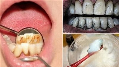 وصفات ازالة البلاك فوراً أختر بين أفضل ١٦ وصفة