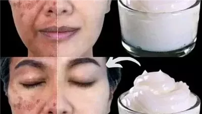 وصفة الحليب والنشا لتفتيح الوجه