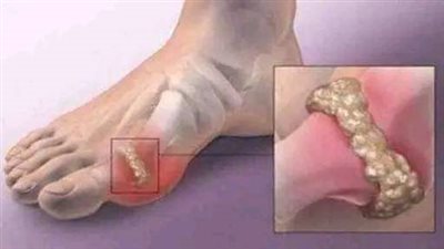 وصفات علاج النقرس بأبسط المكونات