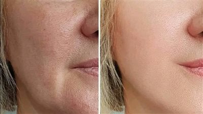  10ماسكات للبشرة العادية للتفتيح بشكل طبيعي وأمن