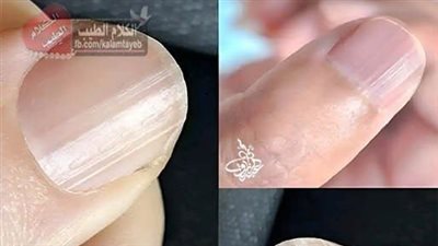 وجود أظافر مخططة قد يعني أن جسمك