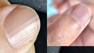 الخطوط على الأظافر أنواعها وأسبابها