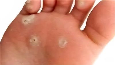 مسمار اللحم او عين السمكة الي تقريبا الطب عجز عنه علاجه ببطانه قشر الموز