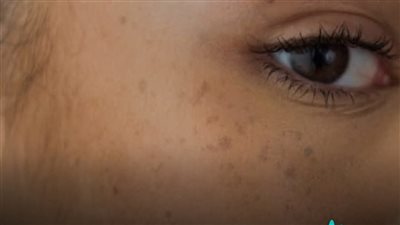 البقع الداكنة بالوجه في الصيف إليكِ طريق الوقاية منها