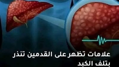 تليف الكبد يتسلل إليك 4 علامات في قدميك تدل على إصابتك بالتليف الكبدي..