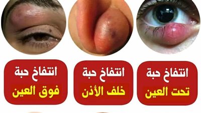 انتفاخ حبه تحت العين