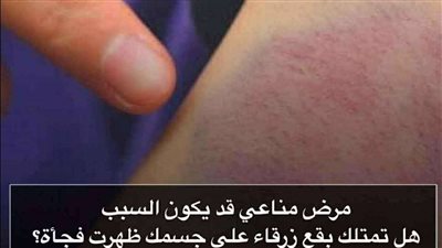 سبب ظهور بقع زرقاء على الجسم قد يكون مرض مناعي