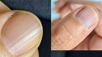 سبب وجود أظافر مخططة