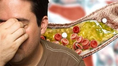 علامات إذا ظهرت على الوجه تدل على ارتفاع الكوليسترول في الډم