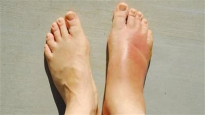 ېهدد حياتك.. 4 علامات في قدميك تدل على إصابتك بالتليف الكبدي