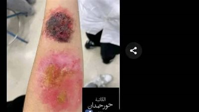 چرح قريب حكاوي 