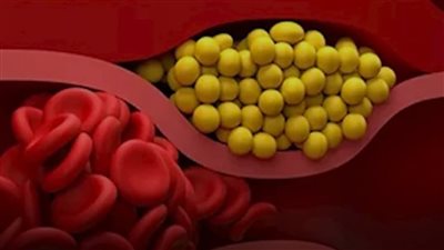 من الرأس للقدم 6 علامات تخبرك بأن كوليسترولك مرتفع