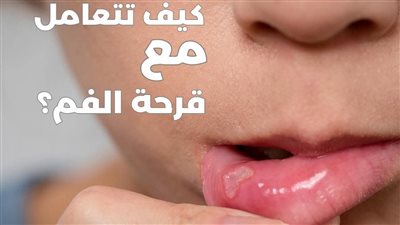 كيفيه علاج قرحه الفم بطريقه سريعة